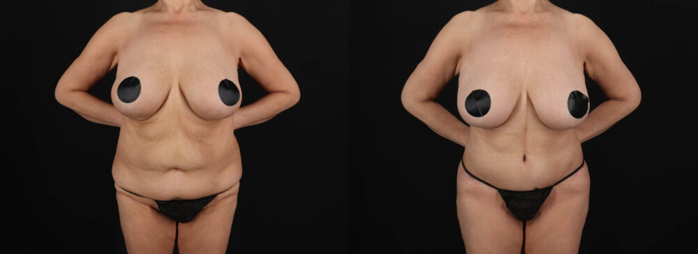 Post Bariatric Surgery (Massive Weight Loss) case #261401