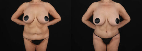 Post Bariatric Surgery (Massive Weight Loss) case #261401