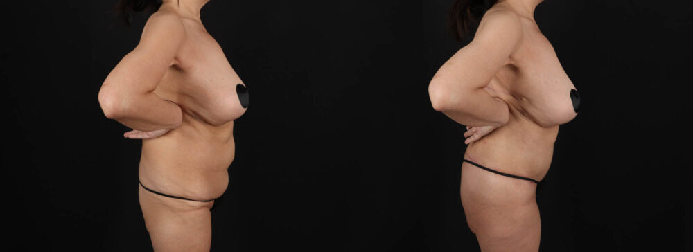 Post Bariatric Surgery (Massive Weight Loss) case #261401