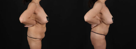 Post Bariatric Surgery (Massive Weight Loss) case #261401