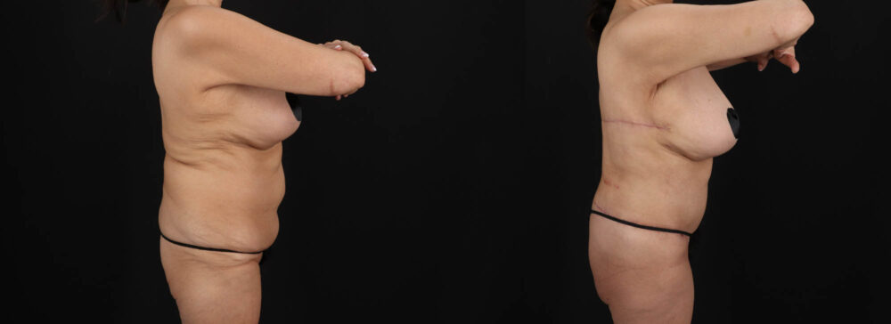 Post Bariatric Surgery (Massive Weight Loss) case #261401