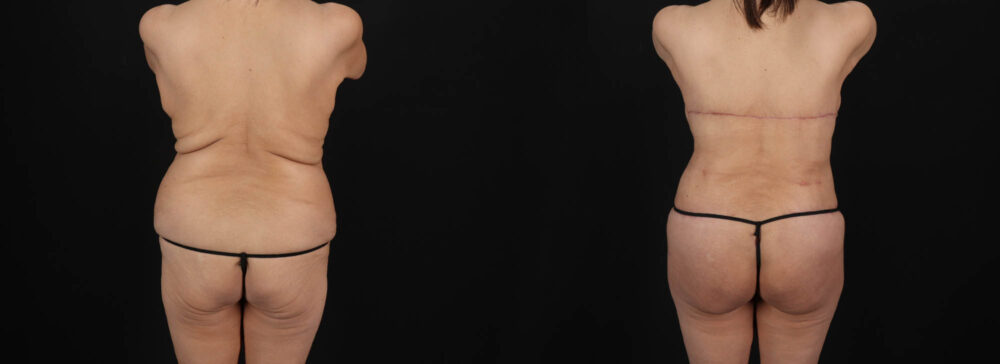 Post Bariatric Surgery (Massive Weight Loss) case #261401