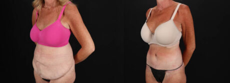 Post Bariatric Surgery (Massive Weight Loss) case #261861