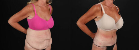 Post Bariatric Surgery (Massive Weight Loss) case #261861