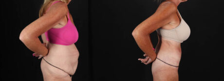 Post Bariatric Surgery (Massive Weight Loss) case #261861