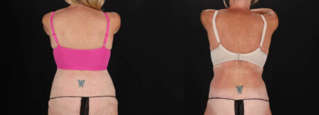 Post Bariatric Surgery (Massive Weight Loss) case #261861