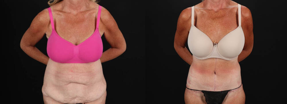 Post Bariatric Surgery (Massive Weight Loss) case #261861