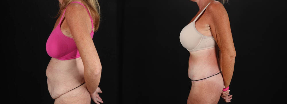 Post Bariatric Surgery (Massive Weight Loss) case #261861