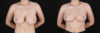 Breast Reduction case #261878 slider thumbnail