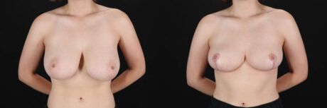 Breast Reduction case #261878