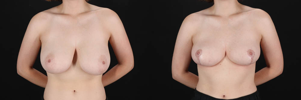 Breast Reduction case #261878