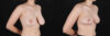 Breast Reduction case #261878 slider thumbnail