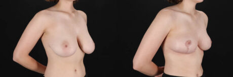 Breast Reduction case #261878