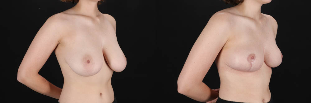 Breast Reduction case #261878