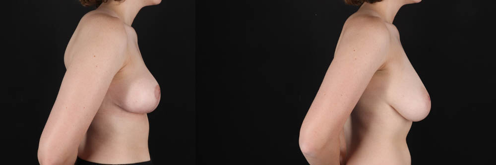 Breast Reduction case #261878