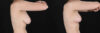 Breast Reduction case #261878 slider thumbnail