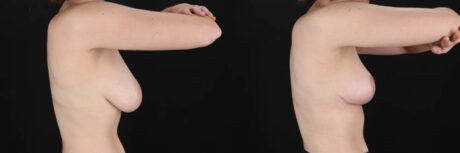 Breast Reduction case #261878