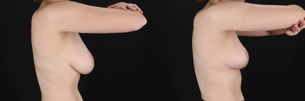 Breast Reduction case #261878