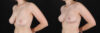 Breast Reduction case #261878 slider thumbnail
