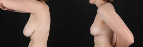 Breast Reduction case #261878