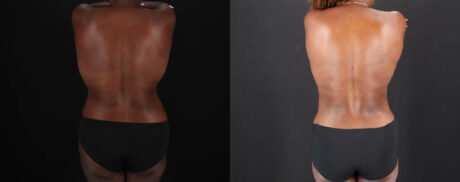 Mommy Makeover case #261346