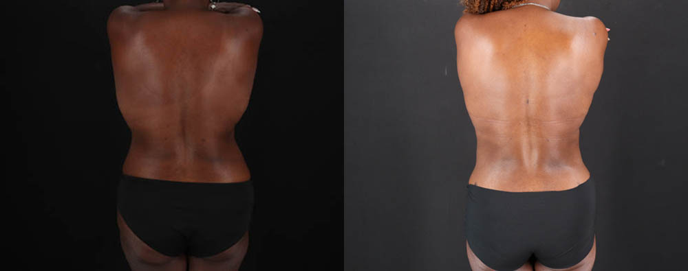 Mommy Makeover case #261346