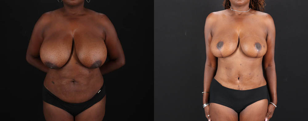 Mommy Makeover case #261346