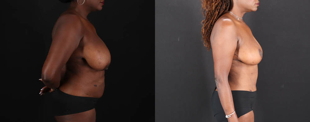 Mommy Makeover case #261346