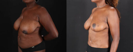 Mommy Makeover case #261346