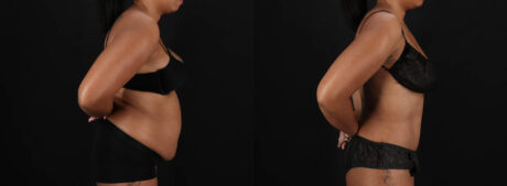 Tummy Tuck case #261849