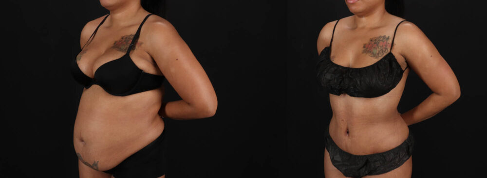 Tummy Tuck case #261849