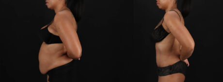 Tummy Tuck case #261849