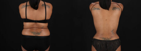 Tummy Tuck case #261849