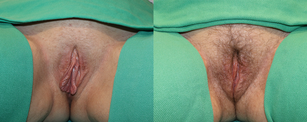Labiaplasty case #261858