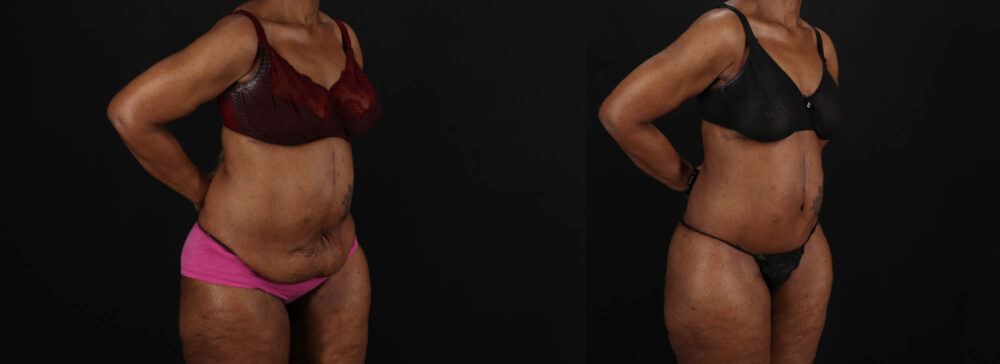 Post Bariatric Surgery (Massive Weight Loss) case #262974