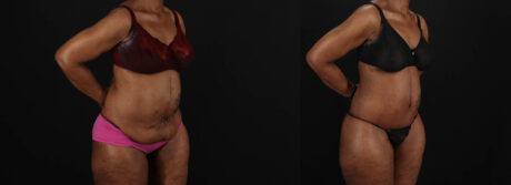 Post Bariatric Surgery (Massive Weight Loss) case #262974