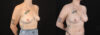 Breast Augmentation case #263023 slider thumbnail