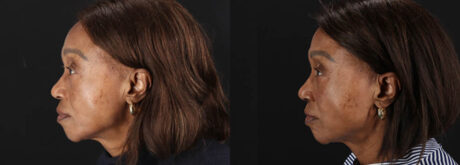 Botox® & Other Neuromodulators case #262991