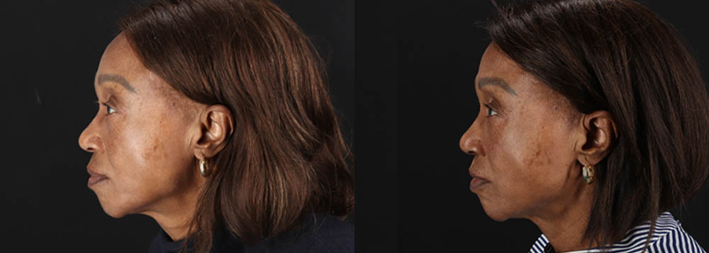 Botox® & Other Neuromodulators case #262991