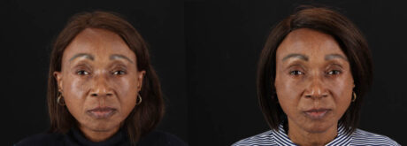 Botox® & Other Neuromodulators case #262991