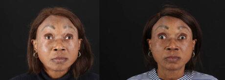 Botox® & Other Neuromodulators case #262991