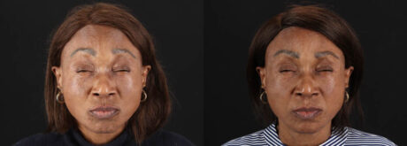 Botox® & Other Neuromodulators case #262991