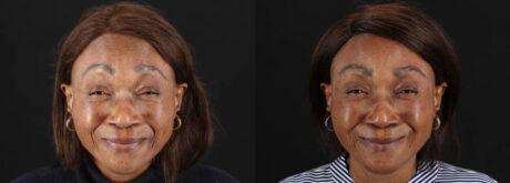 Botox® & Other Neuromodulators case #262991