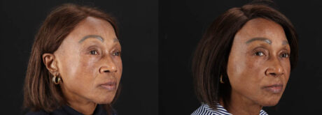 Botox® & Other Neuromodulators case #262991