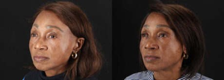 Botox® & Other Neuromodulators case #262991