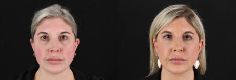 Renuvion RF Skin Tightening case #263029