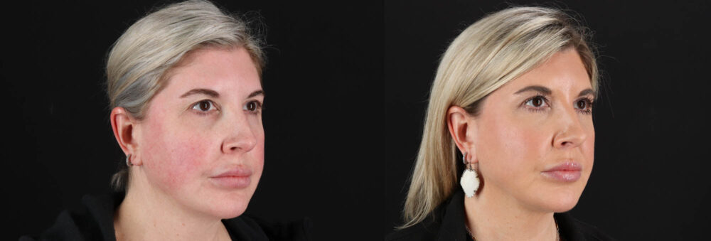 Renuvion RF Skin Tightening case #263029