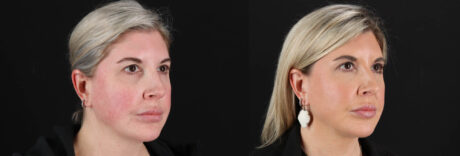 Renuvion RF Skin Tightening case #263029