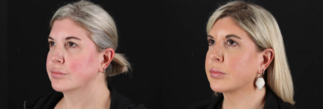 Renuvion RF Skin Tightening case #263029