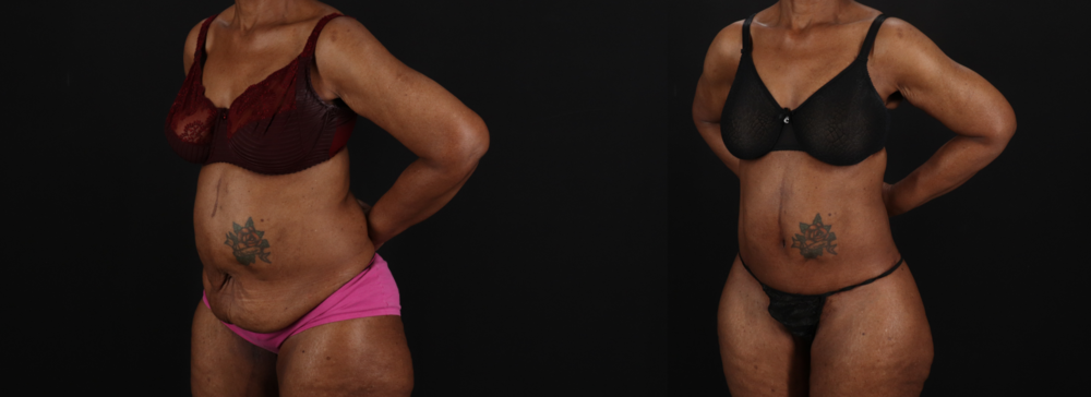 Post Bariatric Surgery (Massive Weight Loss) case #262974